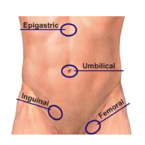 Types of Abdominal Hernias